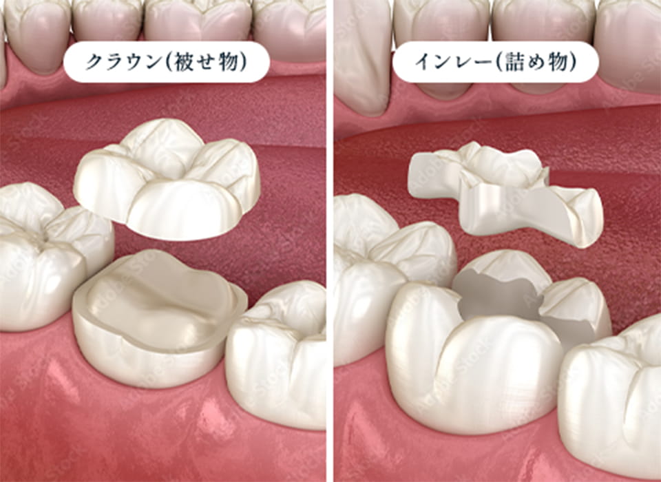 最適な歯科素材で治療跡を新しくほてつ治療