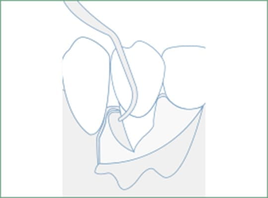 歯肉の剥離プラーク・歯石などの除去