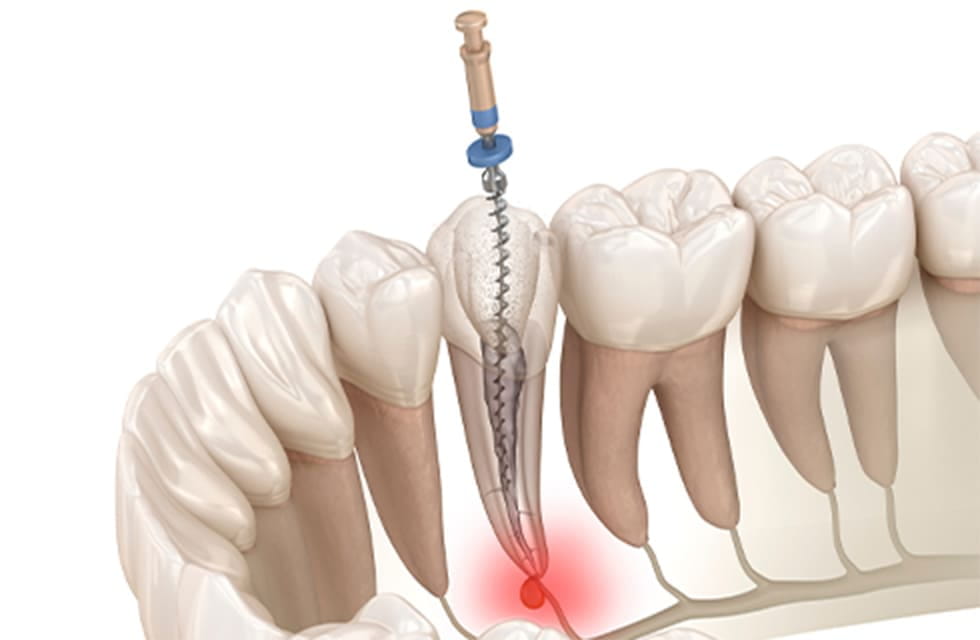 歯内療法（根管治療）