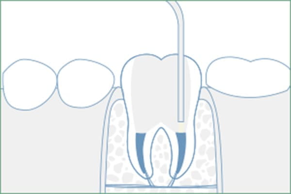 4. 薬剤充填