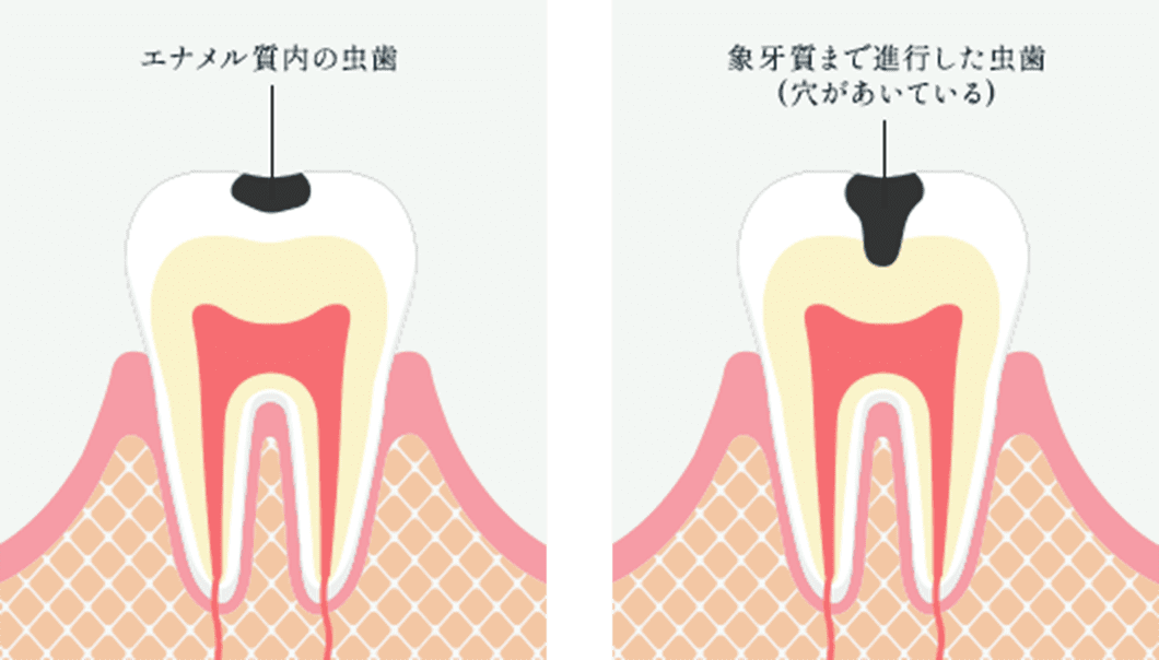 フェーズに適した歯の治療で歯、神経、歯根の温存へつなげる