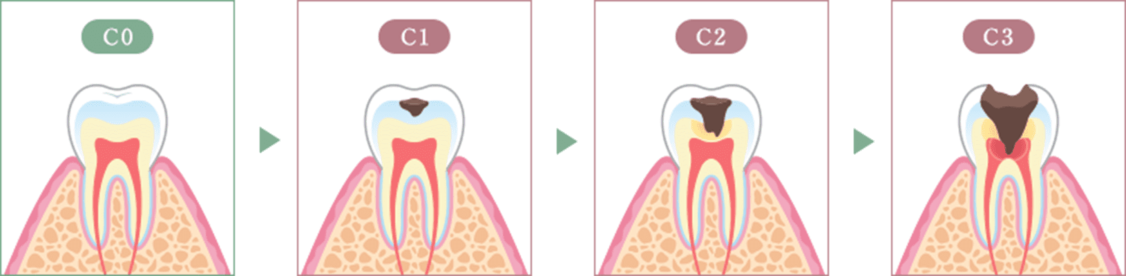むし歯の進行ステージ