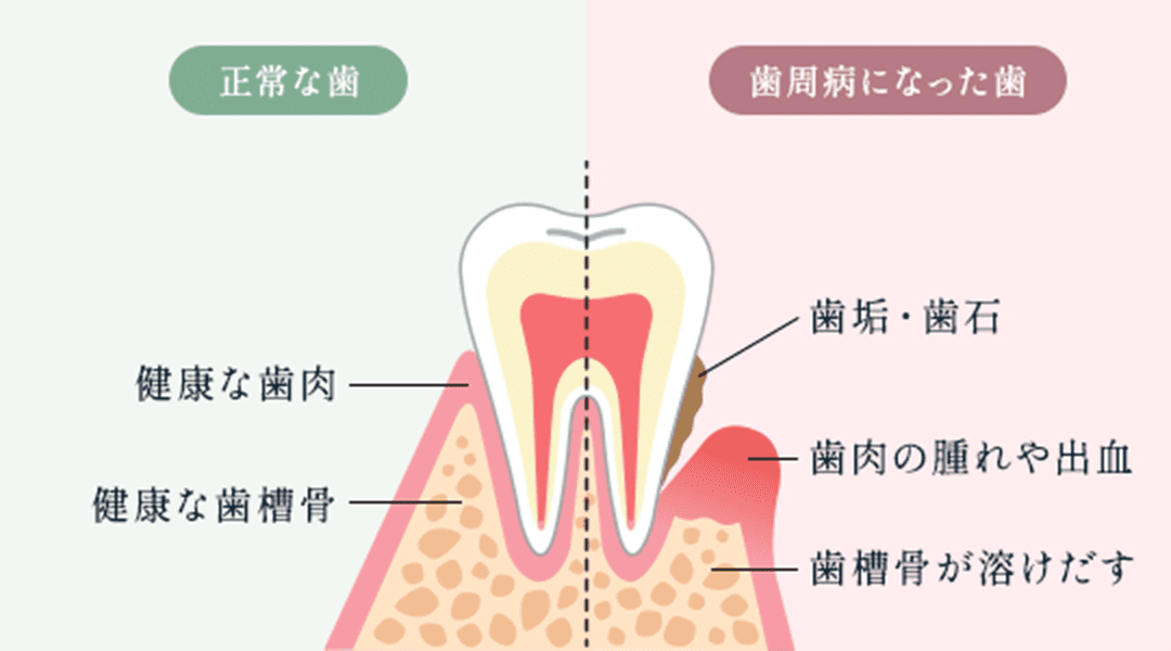 口腔環境を維持する管理で全身疾患を予防する