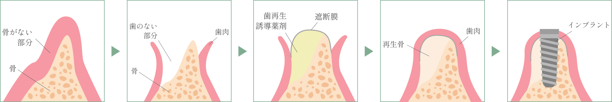 骨再生誘導療法の手順