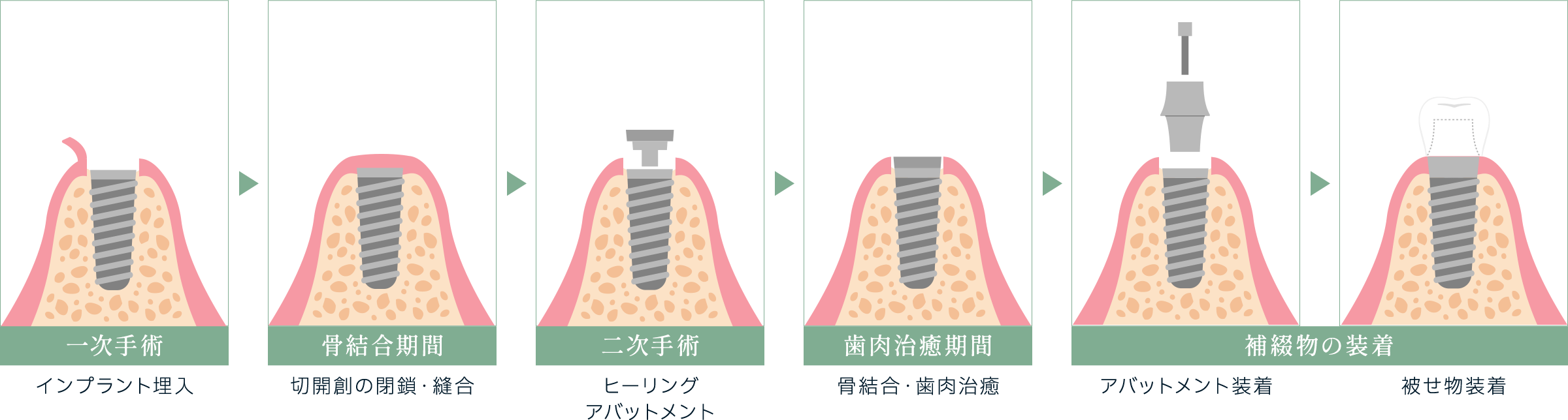 インプラント手術