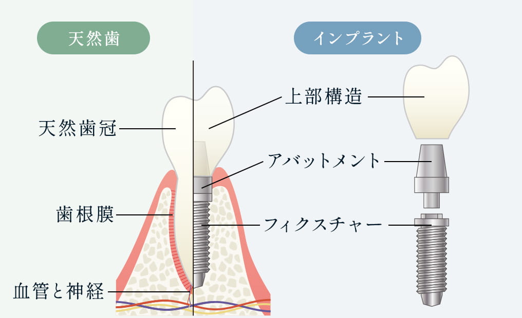 インプラントの構造