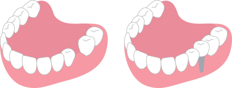 歯を1本失った場合